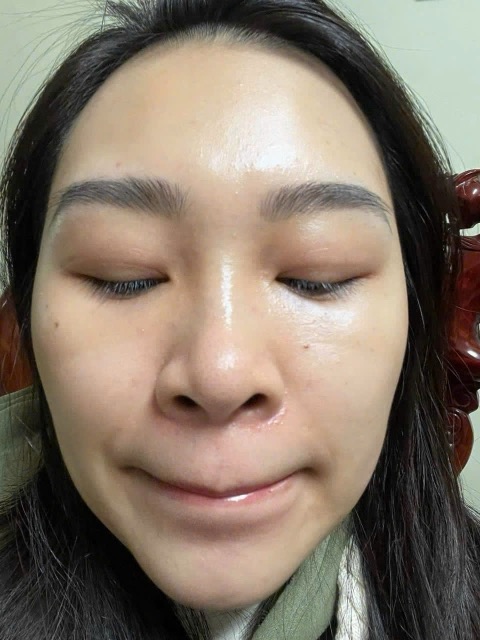 Sau 3 buổi Hydra