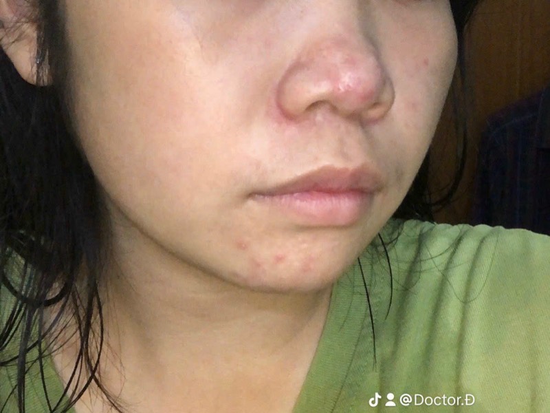 Sau liệu trình
