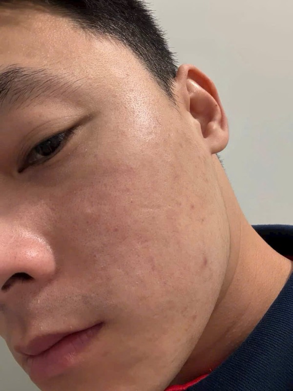 Sau liệu trình