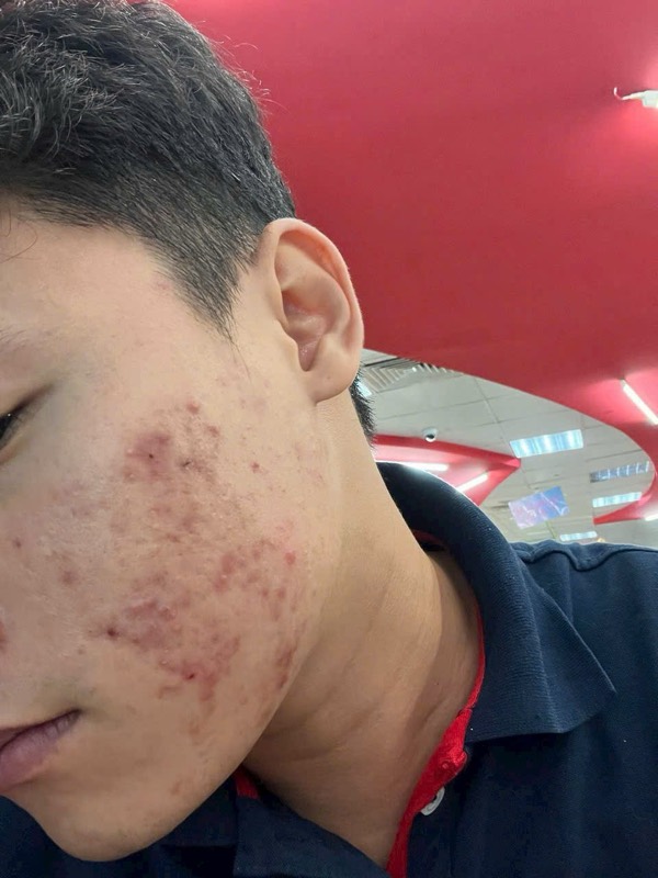 Trước liệu trình