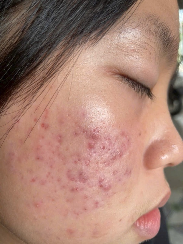 Đang điều trị
